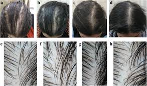 When the world used to though it has a higher formulation of minoxidil than most other treatment products for female hair loss, it is still especially made to address and suit the. Trichogenic Effect Of Topical Ketoconazole Versus Minoxidil 2 In Female Pattern Hair Loss A Clinical And Trichoscopic Evaluation Biomedical Dermatology Full Text