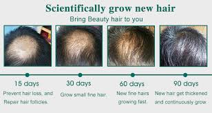Rosemary oil an essential oil, rosemary has strong antiseptic properties that help treat flaky scalp, dandruff and infections—all of which contribute to hair loss. Anti Dandruff Anti Alopecia Organic Herbal Hair Growth Shampoo Hair Loss Treatment Buy China Hair Loss Treatment Organic Shampoo Hair Growth Shampoo Product On Alibaba Com