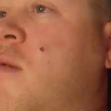 Stomach-churning moment wife spots HUGE festering spot