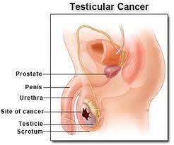 When it shows up in your pee, blood could be a warning sign of a problem in your urinary tract. Testicular Cancer Risk Factors Symptoms Diagnosis Staging Treatment Prognosis