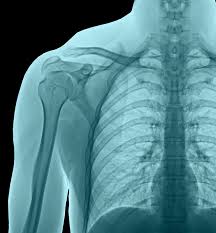 Image result for Chest XRay