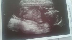 Ob dies der fall ist, erkennt man an den ersten zwei ziffern der achtstelligen zulassungsnummer auf dem seitenwangen, wie diese bei kindersitzen mit rückenlehne vorhanden sind, können also nicht. Konnt Ihr Das Geschlecht Am Po Erkennen Forum Schwangerschaft Urbia De