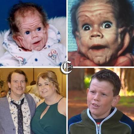 👶🏻🏻🧬🧑🏻‍⚕️Nació y el silencio lo dijo todo: nadie estaba preparado  para ver a un bebé con tanta piel que parecía imposible que ese cuerpo tan  pequeño pudiera cargarla. En 1993, en el