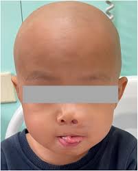 Clinical Characteristics of Children with Nasal BCOR-Rearranged Ewing-like  Sarcoma: A Case Report and Literature Review