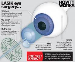 How Does Laser Eye Surgery Work Lasiksurgery Lasik Eye Surgery Eye Surgery Lasik