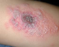 Image result for Spider Bite