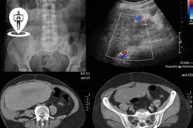 La risonanza magnetica funzionale, abbreviata rmf o fmri (functional magnetic resonance imaging), è una tecnica di imaging biomedico che consiste nell'uso dell'imaging a risonanza magnetica per valutare la funzionalità di un organo o un apparato. Ecografia Addominale Radiologia Italia
