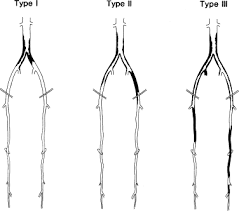 Direct Surgical Repair Of Aortoiliac Occlusive Disease Thoracic Key