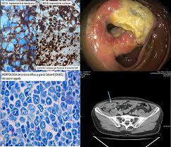 It can show large, more advanced cancers or masses.. A Diffuse Large B Cell Lymphoma Detected During Colorectal Cancer Screening Colonoscopy Digestive And Liver Disease