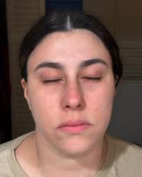 ✨ 1 Week MOXI Transformation: What to Expect ✨,  MOXI is a gentle laser  designed to refresh and revitalize the skin with minimal downtime. Our  wonderful patient was so pleased with her results, she ...