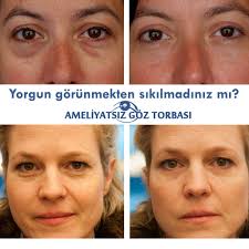 Genellikle 20 Dakika Suren Tedavi Suresince Gozun Etrafina Uyusturucu Krem Ve Anestezi Ignesi Uygulanir Daha Sonra Ucunda Igne Olan Bir El Kolajen Cil Gozler