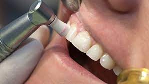 Maybe you would like to learn more about one of these? Deep Cleaning Nhs Dentist London Friendly And Affordable Fernleigh Dental