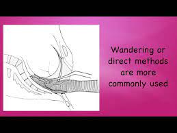 The kielland's forceps are a potentially dangerous instrument in unfamiliar hands. Kielland Forceps Delivery Youtube