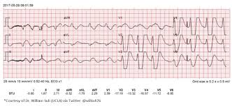 Image result for Pulseless Electrical Activity