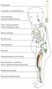 Image result for Craniotabes