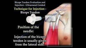 Image result for Biceps Tendon Injection