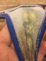 And what does the discharge of bacterial vaginosis look like? answered by dr. Yeast Infection Of Bv Please Help Glow Community