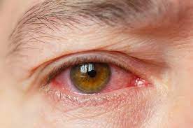 Hornhautentzundung Ursachen Symptome Behandlung Lasik Germany