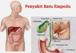 Dalam banyak kasus, gejala anda, dikombinasikan dengan kesakitan di sisi kanan atas perut anda, akan mengingatkan dokter bahwa hal tersebut mungkin batu empedu. Batu Empedu Gejala Penyebab Dan Cara Mengobati Insuring Your Loves Jagaharta Id