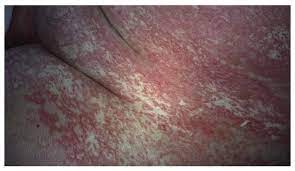 Staphylococcal Scalded Skin Syndrome In An Adult Immunocompetent Patient