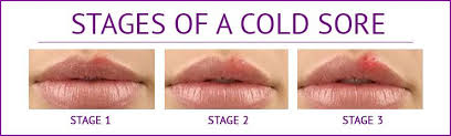 Medically reviewed by cynthia cobb, dnp. Managing A Cold Sore Outbreak Allure Medical