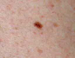 So, what exactly does skin cancer look like? Exactly What Cancer Looks Like Glamour