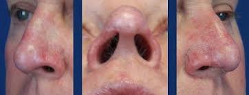 Basal cell skin cancer is the most common form of skin cancer. Facial Skin Cancer Reconstruction Musc Health Charleston Sc