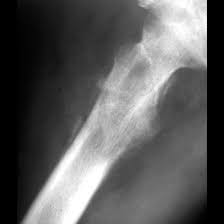 Image result for Ewing Sarcoma