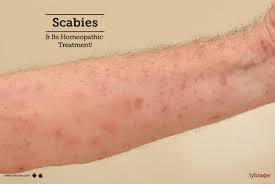 Image result for scabies human children
