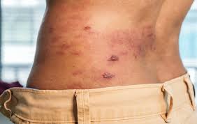 Image result for shingles