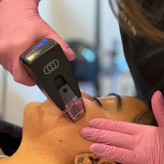 Morpheus8 Skin Tightening in Luton - Skin House