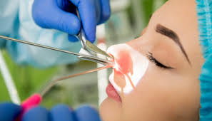 Image result for Sinus Surgery