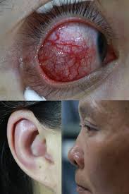 Image result for Relapsing Polychondritis