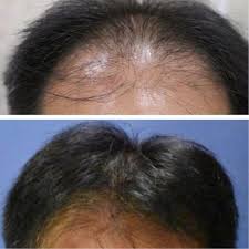 Beberapa hal boleh menyebabkan rambut gugur berlebihan. Rambut Anda Akan Tumbuh Lebat Jika Menggunakan Ini