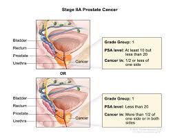 Md hello, i think you can give a try to additional treatment with antiandrogen.this will bring done psa and also testosterone.it will help metastatic disease as well.regards. Prostate Cancer Hematology Oncology Associates Of Cny