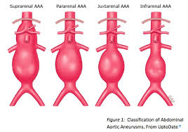 Pin By Joy Hogan On Nursing Abdominal Aortic Aneurysm