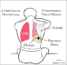 Image result for Thoracentesis