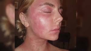 Image result for ekzema face