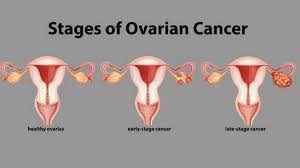 Ovarian cancer is cancer that affects one or both ovaries. Ovarian Cancer The Silent Killer Lifestyle General Kerala Kaumudi Online