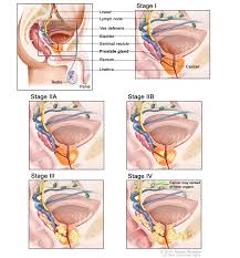 Image result for Prostate Cancer Staging
