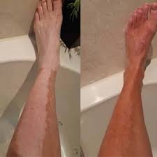 They may be dry and scaly and may itch or hurt, although this is not common. Self Tanner For Vitiligo Pigment Spots Cellulite Scars Or Varicose Veins Vitiligoshop