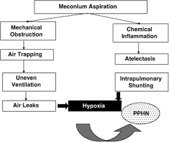 Extracorporeal Membrane Oxygenation Use In Meconium Aspiration Syndrome Journal Of Perinatology