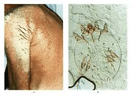 Image result for scabies norvegica