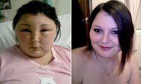 My Head Turned Into A Football Shocking Pictures Show Swollen Face Of Woman 25 After Allergic Reaction To Home Colouring Kit Hair Dye Allergy Swollen Face Dyed Hair