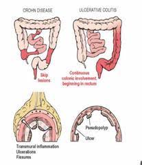 Tortuous Colon And Weight Gain