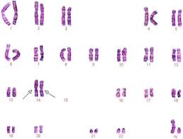 Robertsonian translocations are a particular type of balanced translocation that get their name from an american scientist who first described them. A Family With Robertsonian Translocation A Potential Mechanism Of Speciation In Humans Molecular Cytogenetics Full Text