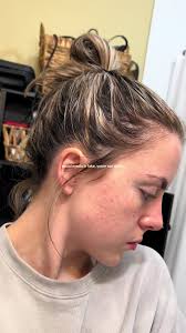 scars from my teenage years full of terrible acne and nights spent picking  at every imperfection