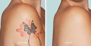 Perform 100 laser hair removal procedures within 12 months under the direct supervision of a senior laser hair removal technician or laser. Laser Tattoo Removal Process All You Need To Know By Premium Tattoo Removal Medium