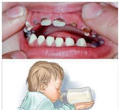 Dentaltown Please Don T Put Your Baby To Bed With A Bottle Of Milk Or Juice This Habit Can Lead To Earl Baby Tooth Decay Baby Bottle Tooth Decay Tooth Decay