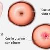 Suele dar síntomas en las fases iniciales de la enfermedad, por lo que en general, en el momento del diagnóstico la mayoría de los tumores están localizados en el. Https Encrypted Tbn0 Gstatic Com Images Q Tbn And9gcthvnekruevgqwgqsumsxk2qb0eszu Gfkazuyeqpi4hmi I6i Usqp Cau